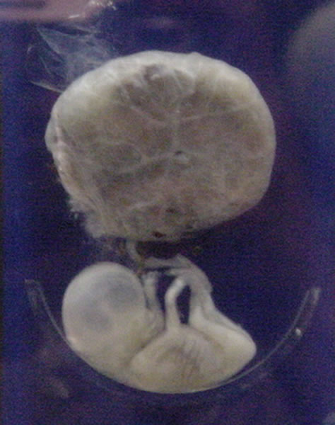 fetus.jpg